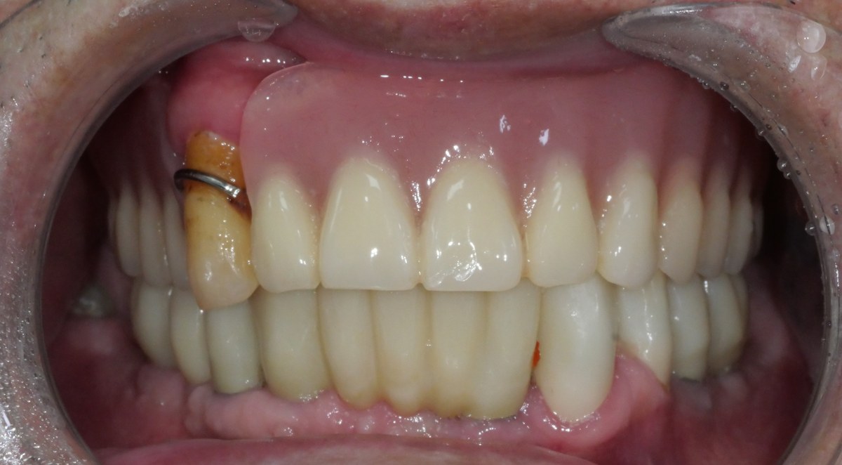임플란트와 부분 틀니 치료 후 — 기능과 심미가 회복된 모습 (연세더튼튼치과 증례)