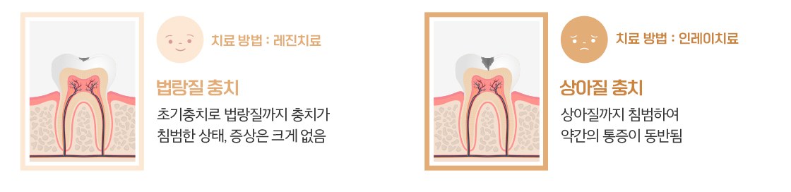 충치 진행 단계 일러스트 — 법랑질 충치는 레진 치료, 상아질 충치는 인레이 치료