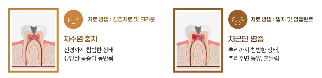 충치 진행 단계 일러스트 — 신경까지 침범한 치수염 충치는 신경치료와 크라운, 뿌리 끝까지 번진 치근단 염증은 발치가 거론되는 단계