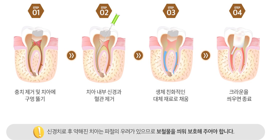 신경치료 4단계 일러스트 — 1단계 충치 제거와 치아에 구멍 뚫기, 2단계 치아 내부 신경과 혈관 제거, 3단계 생체 친화적인 대체 재료로 채움, 4단계 크라운을 씌우면 종료