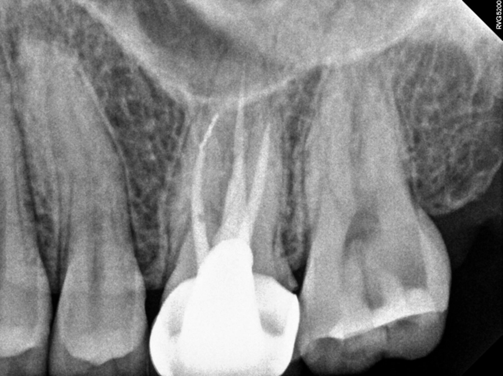 신경치료 전 치근단 X-ray — 뿌리 끝 주변 염증 부위